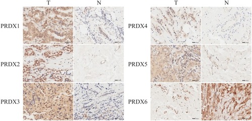 Figure 4 The expression of PRDX family in breast cancer (IHC).