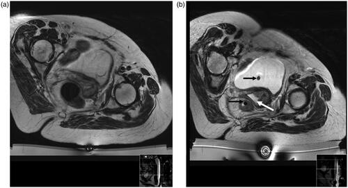 Figure 1. Patient with central recurrence in position within the MRI scanner with the HIFU device in place. T2-W image at planning study (a) and on day of treatment (b) after bowel and bladder preparation. In b, urinary and rectal catheters (black arrows) are noted in situ. The vagina is filled with degassed gel (white arrow).
