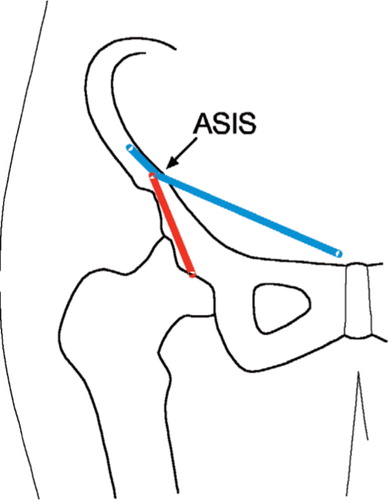 Figure 2. Lines of skin incisions for the ilioinguinal approach (blue line) and for the minimally invasive approach (red line) in relation to the bones. The anterior superior iliac spine (ASIS) is marked.