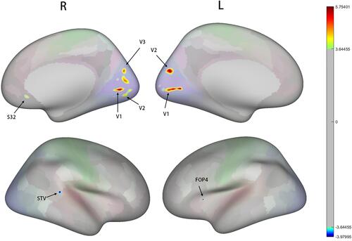 Figure 1 Brain regions with significant differences in cortical thickness in PHN patients compared with HCs.