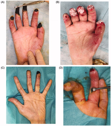 Figure 4. All five fingers on the right hand and the ring finger on the left hand showed necrosis. All necrotic tissues, including the bone, were excised. Artificial dermis was used to cover the wounds of the right hand after amputation. (A) The right hand before amputation, (B) right hand with artificial dermis, (C) left hand before amputation, (D) left ring finger after amputation.