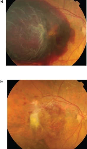 Figure 1 Female aged 89 years (patient no. 5). Baseline fundus photograph (a) and 2 months after the surgery (b). Visual acuity improved from 20/1000 to 20/400. No further treatment was needed during the 12-month follow-up.