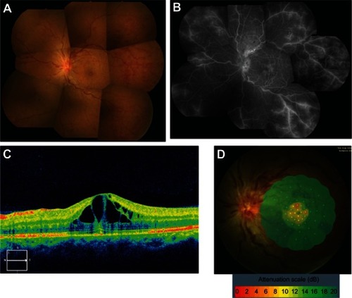 Figure 1 Fundus color photograph (A) of our patient with systemic lupus erythematosus, showing unilateral central retinal vein occlusion. Superficial and deep intraretinal hemorrhages are scattered throughout the retina. Fluorescein angiogram (B) shows a pattern resembling cystoid macular edema (CME) without ischemia of the macula or the peripheral retina. Optical coherence tomography (C) reveals retinal swelling and CME. Fundus-monitored microperimetry with the MP-1 system (D) indicates a cessation of foveal sensitivity.