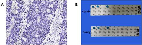 Figure 3 Immunohistochemical staining and polymerase chain reaction results of the cervical lesion. (A) Tumor cell nuclei were negative for estrogen receptor. (B) The presence of human type 18 papillomavirus in cervical and ovarian tissue.