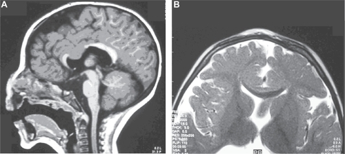 Figure 3 A–B Magnetic resonance imaging of the brain of case 1.