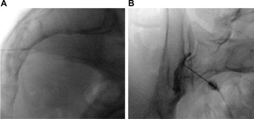 Figure 1 Sacroiliac joint injection.