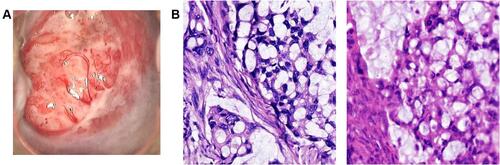 Figure 1 Primary signet-ring cell carcinoma of the uterine cervix in the biopsy. (A) Colposcope image of the cervical mass. (B) Histopathological findings of the cervical (left) and ovarian (right) lesion (hematoxylin and eosin stain, ×200 magnification).