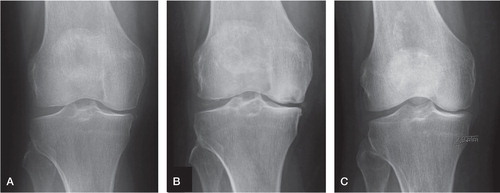 Figure 2. A. An 82-year-old women suddenly noticed pain in her right knee. A mild osteoarthritis was seen and regarded as the cause of the symptoms. No treatment was given. (This radiograph was taken 1 month after start of symptoms). B. One year after start of symptoms, the symptoms were the same and a visible osteonecrosis was now seen with a Lotke index of 33%. The patient was referred to our department. C. The patient was treated for 13 months. Radiograph taken at follow-up 2 years after the start of treatment. The ostenecrosis had healed completely but the patient had developed mild osteoarthritis of Ahlbäck grade 1.