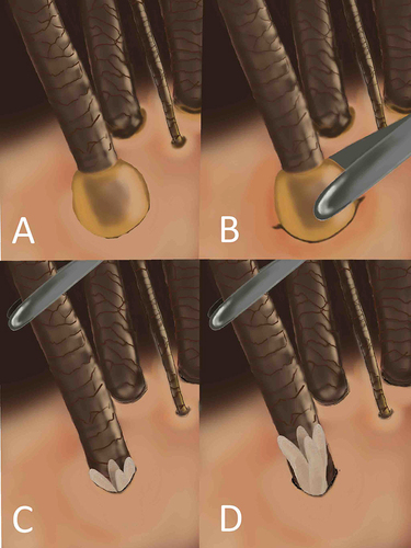 Figure 1 Technique for identifying the Demodex mite. Cylindrical dandruff (A) is sought and removed (B), then the hair follicle is manipulated (C) to reveal Demodex mites (D).