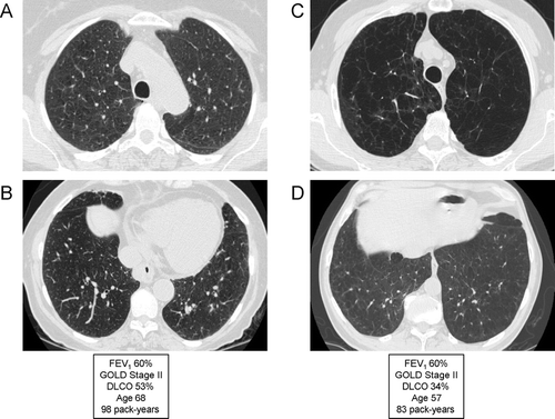 Figure 17 Variable emphysema severity with similar degree of airflow limitation (FEV1). (A) and (B) are from the same patient, and demonstrate mild-to-moderate centrilobular emphysema (CLE) with an upper lobe predominance (A). (C) and (D) are from a different patient, demonstrating moderate-to-severe CLE with an upper lobe predominance (C). Despite the marked visual differences in emphysema severity, the patients are matched for degree of airflow limitation; note that the DLCO correlates better with emphysema severity than the FEV1.