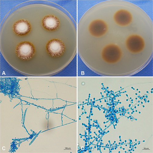 Figure 2 The strain was cultured on SDA at 28 °C for 1 week. The images of colony showing white colonies peripherally radiating, centrally raised, and powdery margins (A), and the reverse side showed yellow to brown colonies (B). The strain staining with lactophenol cotton blue was observed under light microscope showing filamentous and spiral hyphae, microconidia and macroconidia (original magnification × 200) (C), and a grape-like arrangement of microconidia laterally and terminally inserting at the hyphae (original magnification × 400) (D).