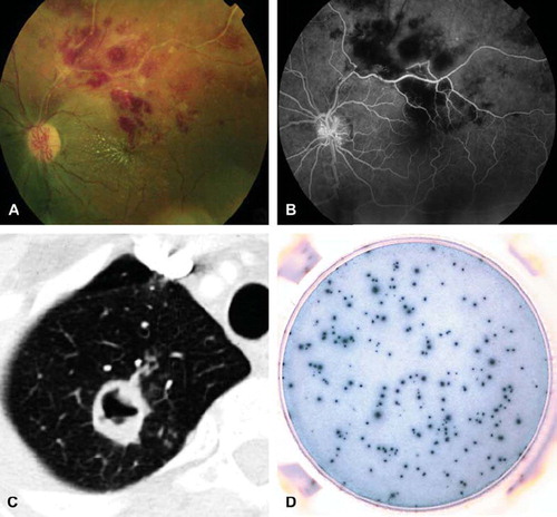 Figure 1. Patient with proved tuberculosis. A: Photograph of the fundus showing retinal hemorrhages and occlusive vasculitis of the left eye. B: Fluorescein angiography of the left eye showing vasculitis, with absence of dye filling in some retinal arteries masking retinal hemorrhages. C: Tuberculous cavitation on CT scan. D: Highly positive T-SPOT®.TB test (panel A, ESAT-6 = 177 spots).