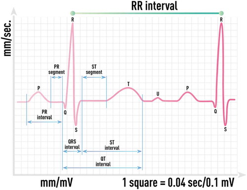 Figure 18. Schematic of ECG waveform and its main elements: the P wave representing the depolarization of the atria, the QRS complex representing the depolarization of the ventricles, the T wave representing the repolarization of the ventricles and others. Inter-beat interval signal (R-R time series) can be extracted with high accuracy even from noisy ECG waveform recordings.
