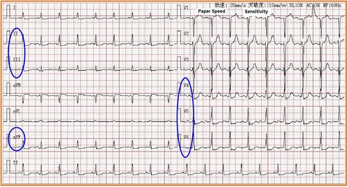 Figure 1 Electrocardiogram of the patient (the blue circles: II, III, aVF, V4~V6, ST segment was significantly depressed).