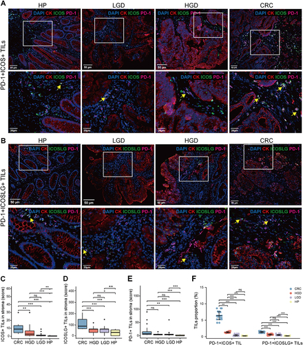 Figure 6 Multiplex immunohistochemical analysis of the co-expression of ICOS/ICOSLG and PD-1 infiltration in the progression of precancerous–carcinoma lesions. (A and B) Representative images of PD-1+ICOS+ (A) and PD-1+ICOSLG+ T cells (B) in HP, LGD, HGD and CRC tissues from the clinical cohort. (C–E) Multiple comparison of the density of ICOS+ (C), ICOSLG+ (D), and PD-1+ (E) T cells in HP, LGD, HGD, or CRC tissues from the clinical cohort. (F) Multiple comparison of the density of PD-1+ICOS+ or PD-1+ICOSLG+ T cells in HP, LGD, HGD, or CRC tissues from the clinical cohort. Nuclei (DAPI, blue), CK (cytoplasm, Opal 650, red), ICOS/ICOSLG (cytoplasm/membrane, Opal 520, green), PD-1 (cytoplasm, Opal 570, pink). Upper panel, Bar scale= 50 μm; lower panel, Bar scale= 20 μm. *p < 0.05, **p < 0.01, ***p < 0.001.