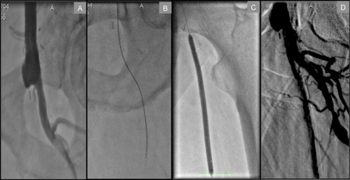 Figure 1 Transradial approach to a left proximal SFA total occlusion in a patient with a history of aorto-bifemoral bypass. A) Distal anastamosis site of bypass conduit to CFA and total occlusion of SFA at its ostium. B) Crosser CTO recanalization catheter™ (Flowcardia) successfully passing through proximal total occlusion. C) Balloon angioplasty of proximal SFA. D) Final result at the end of procedure.
