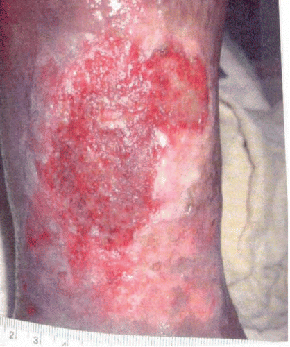 Figure 2 Leg ulcer prior to initiation of androgen therapy.