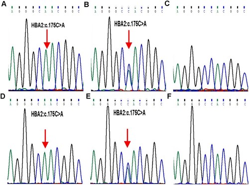 Figure 2. DNA and RNA analysis results of each family member. DNA (A-C) and RNA (D-F) results of the α2-globin gene indicated a homozygous and heterozygous variant of HBA2:c.175C > A (red arrow) in proband (A and D) and father (B and E), respectively, which was not identified in mother (C and F). Further, an equal ratio of normal and mutant alleles could be observed from cDNA sequencing result in the heterozygote father (E).