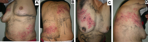 Figure 1 Painful papules and small blisters are distributed in clusters on the basis of flaky erythema, arranged in a band from the left abdomen (A) to the back (B), and on the right from the chest (C) extending in a band to the axillae (D) and back. Black dotted crusts of ink are scattered on the erythema, and black ink spots are painted around the rash (folklore “circling method”, using ink circles around the lesions).