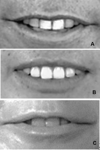 Figure 2 Three kinds of position relations between upper central incisors edge and lower lip. (A) Separate; (B) contact; (C) overlap.