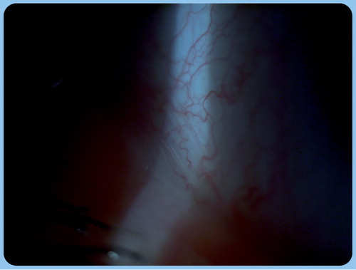 Figure 3. Severe dry eye with multiple, higher than normal tear meniscus lid-parallel conjunctival folds (lid-parallel conjunctival fold grade 3).