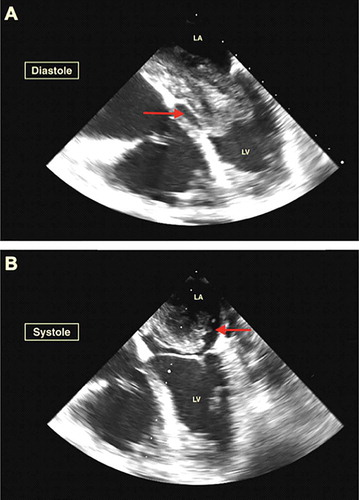 Figure 2. Panel A (Diastole) & B (Systole) Transesophageal echocardiogram revealed a giant 5.5 × 4.5 cm mobile density likely myxoma attached to the interatrial septum and prolapsing into the left ventricle during the diastolic phase causing functional mitral stenosis
