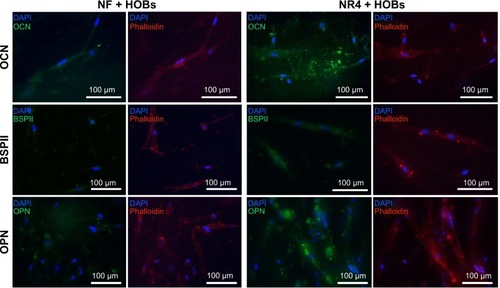 Figure 4 In vitro effect of BMP-7 nanoreservoirs on osteogenic differentiation of human osteoblasts.Notes: In vitro expression of OCN, BSPII, and OPN in HOBs after 21 days of cell culture onto the PCL bare scaffolds (NF) or those equipped with BMP-7 nanocontainers (NR4). The nucleus was stained with DAPI (in blue), actin labelled with phalloidin (in red), and OCN, BSPII, and OPN were stained in green. For all images, scale bars =100 μm.Abbreviations: BSPII, bone sialoprotein II; HOBs, human primary osteoblasts; NF, not functionalized; NR4, functionalized with (chitosan/BMP-7)4 nanocontainers; OCN, osteocalcin; OPN, osteopontin; PCL, poly(ε-caprolactone).