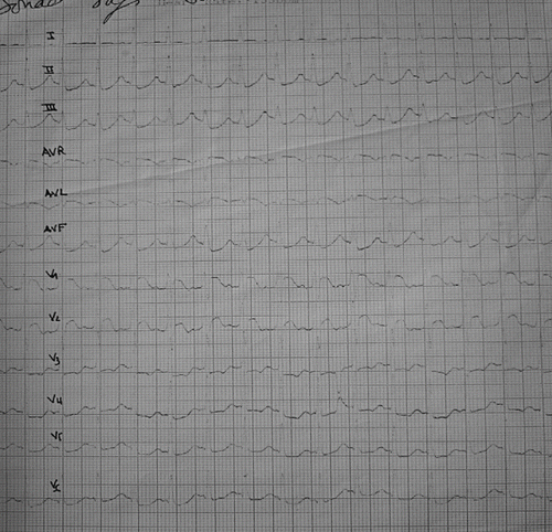 Fig. 1. Electrocardiogram at admission of the first case showing ST-segment elevation in the leads V1 and V2.