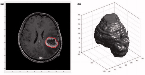 Figure 1. An example of segmentation result of glioma. (a) Segmentation results of a piece of T1 Contrast MRI image and (b) segmentation results in three dimensions.