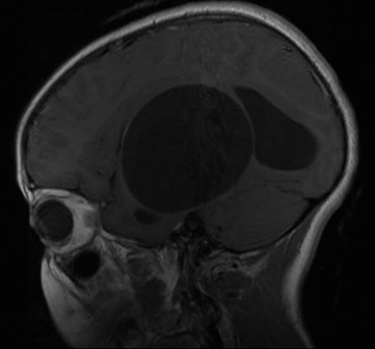 Figure 3 T1-weighted MRI of the brain after gadolinium administration showing a well-defined cystic mass with no enhancement on the cyst wall.