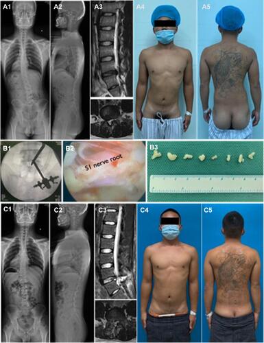 Figure 2 A 24-year-old male LDH patient with right leg sciatica present spinal coronal imbalance (A1-2). L5/S1 right side disc herniation was shown in MRI (A3). X-ray (A1-2) and physical appearance (A4-5) showed the trunk shifted to left side in coronal plane. UBED surgery was performed (B1-3) and postoperative MRI showed herniated disc was removed (C3). X-ray (C1-2) and physical appearance (C4-5) showed coronal imbalance acquired recovery immediately after surgery. (As it is possible the patient could be identified by the tattoo on his back, he has provided informed consent for the images to be published.).