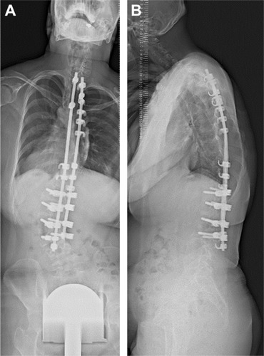 Figure 1 Radiographs of posterior spinal correction surgery.