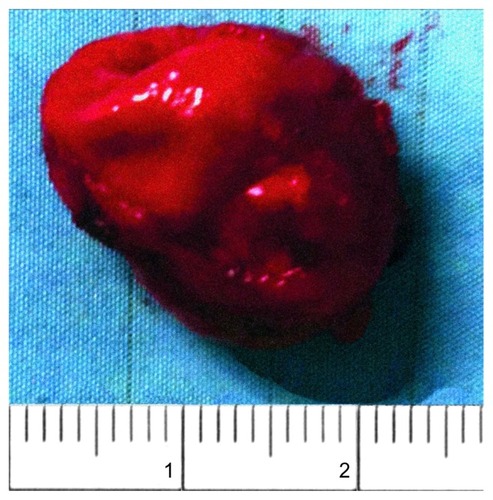 Figure 3 Surgical specimen of renal metastasis.