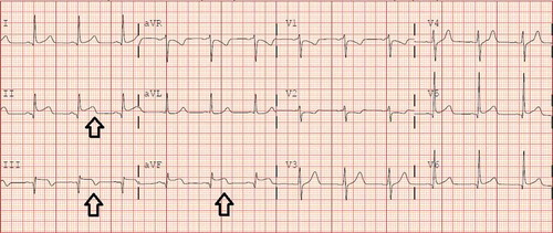 Figure 1. Resting 12-lead electrocardiogram (EKG) showing ST elevation in inferior leads II, III and aVF (see the black arrows).