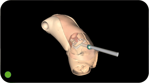 Figure 4. The Computer Guidance Module during a simulated cholecystectomy, working in ASSISTIVE modality. In this modality, the surgeon is able to load the planned position for the single access port, as decided using the Planning and Simulation Module during the preoperative phase. The optimal port placement is marked on the virtual abdomen of the patient, assisting the surgeon in the insertion of the trocar.