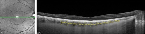 Figure 1 Measurements of choroidal thickness at 10 locations.