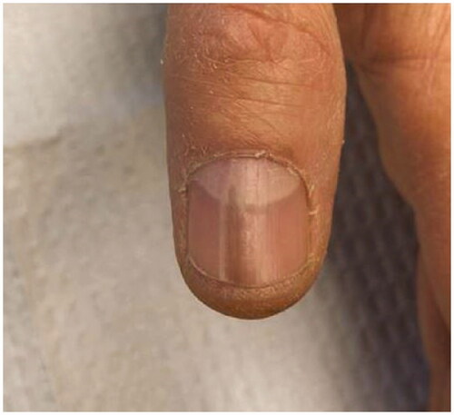 Figure 1. Right thumb. Longitudinal dark stripe beginning at the level of the distal lunula.