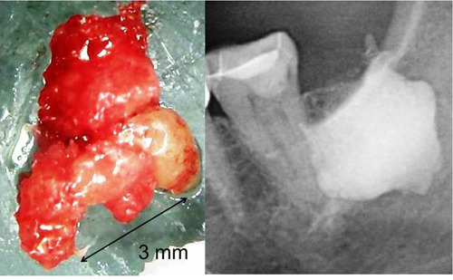 Figure 1 FDOJ sample of osteolytic degeneration of the bone marrow with fat (left image) and FDOJ cavity filled with contrast medium after curettage (right image) show the extent of the osteolytic process inside the bone marrow.