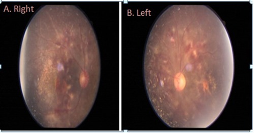 Figure 3 Fundus photograph showing resolution of optic disc swelling, cotton wool spots, hemorrhages, and hard exudates after two doses of intravitreal bevacizumab and dexamethasone. (A) Right eye. (B) Left eye.