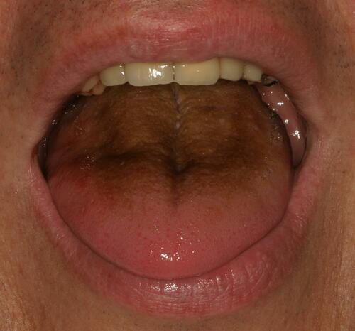 Figure 1 Tongue coating.