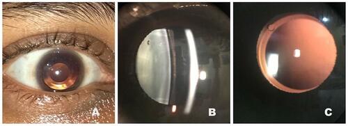 Figure 2 (A, B, and C) Postoperative lens position on pupillary dilatation in slit lamp.