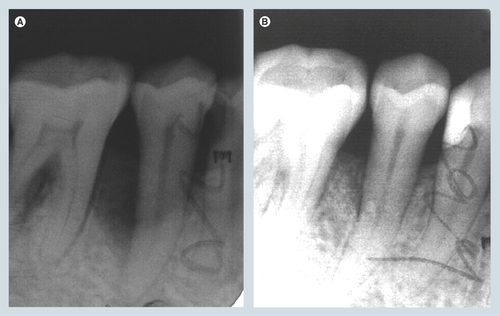 Figure 4.  Periapical radiograph of the second right mandibular premolar 1 year post-surgery.