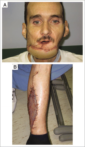 Figure 1 (A) A 48 year old patient following free fibular osteocutaneous composite reconstruction of a defect involving mandible, chin, lower lip and oral mucosa. (B) The typical donor site defect. Today's indications for free tissue transfer will likely be tomorrow's indications for composite tissue allotransplantation.