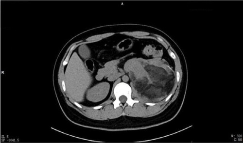 Figure 2 Axial plane showing adipose tissue and septations.Notes: Tiny foci of calcifications are also visible in the lateral wall of the mass.