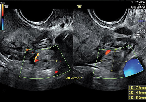 Figure 8. Left ectopic pregnancy.