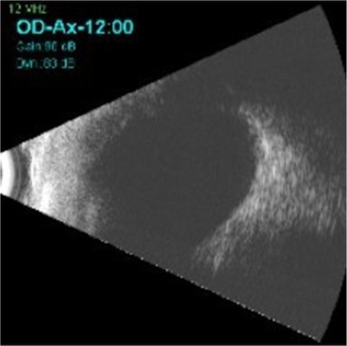 Figure 3 B-scan ultrasonography confirming normal posterior pole of the right eye.