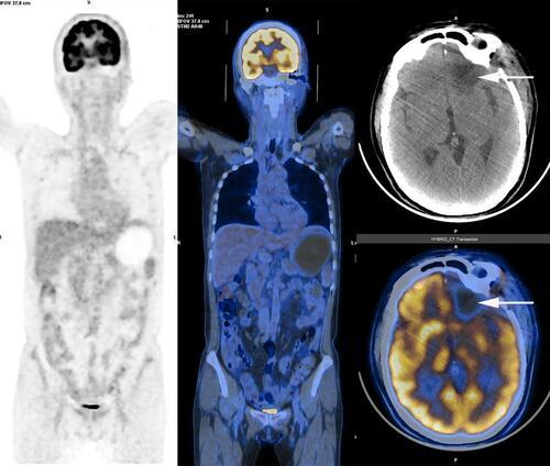 Figure 4 PET/CT scan (after surgery and before chemotherapy). The PET/CT scan revealed that the foci (arrows) showed postoperative changes with sparse fluorodeoxyglucose uptake, but no foci of increased uptake elsewhere in the body.