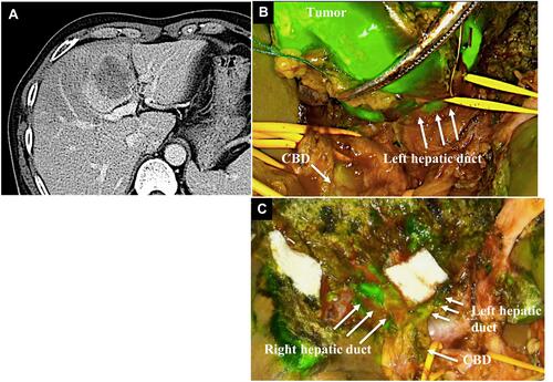 Figure 3 Case 3 The tumor was located by the left Glissonian pedicle (A). The common hepatic duct (CBD) and left hepatic duct were visualized by the injection of ICG (B). The biliary structure was preserved and showed fluorescence after resecting tumor resection (C).