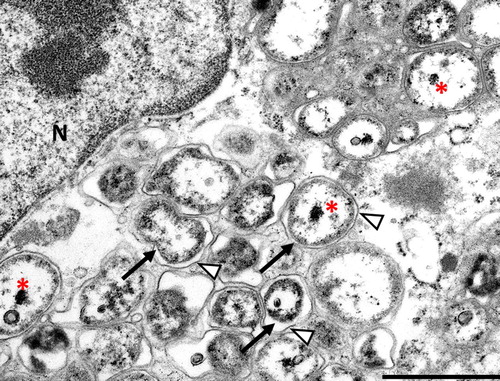 Figure 2. Coxiellosis in hyacinth macaw (case 2). Transmission electron micrograph, 14,000×. A macrophage in the spleen contains myriad intracellular bacteria, with peripheralization of the nucleus (N). The membrane of the parasitophorous vacuole (arrowhead) can be seen associated with bacteria (arrow), some of which have a characteristic electron dense core (asterisk). N – host cell nucleus. Bar = 0.5 µm.