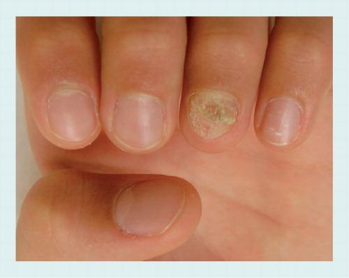 Figure 9. Nail psoriasis of the fourth left fingernail in a 5-year-old girl.Diffuse crumbling of the nail plate.